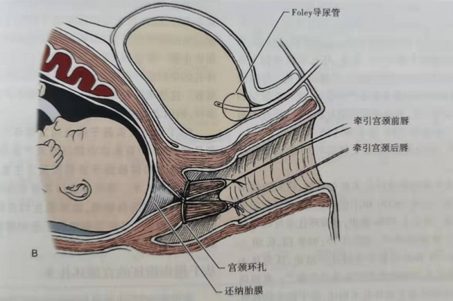 苏州一孕妇遭遇宫颈机能不全，医生妙手缝扎守住胎儿“安全门”