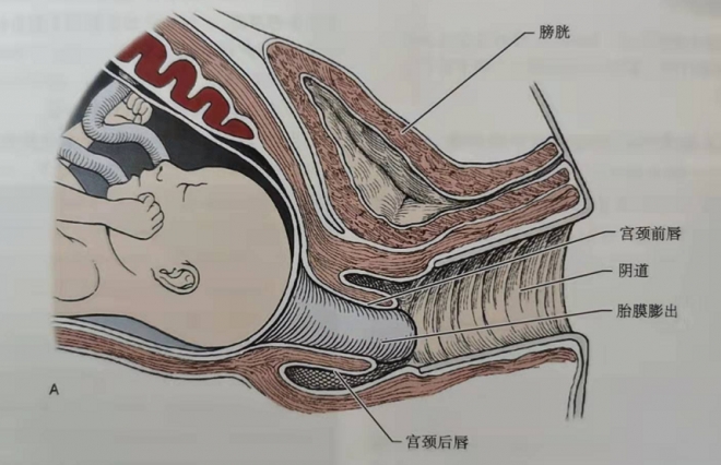 苏州一孕妇遭遇宫颈机能不全，医生妙手缝扎守住胎儿“安全门”