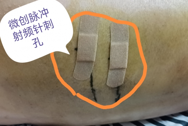 出现莫名水泡皮疹需警惕，苏州一耄耋老人因此半年多无法正常入睡