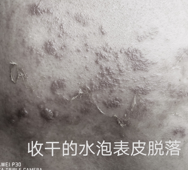 出现莫名水泡皮疹需警惕，苏州一耄耋老人因此半年多无法正常入睡