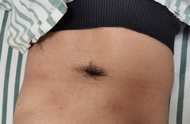 苏州一小伙腰部凹陷还长毛发，专家团队手术治疗罕见怪病