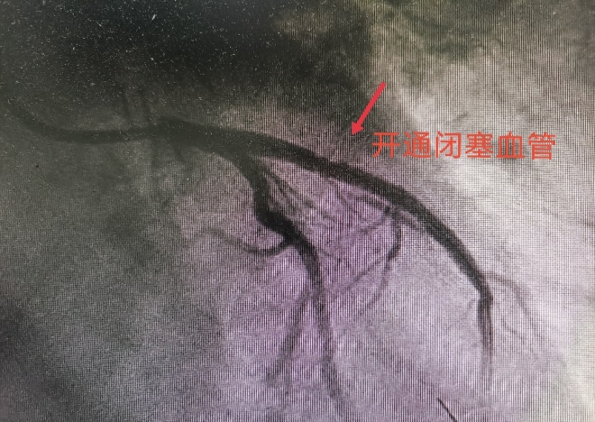 五旬外地司机突发胸痛，苏州市中医医院紧急开展一场生命的接力
