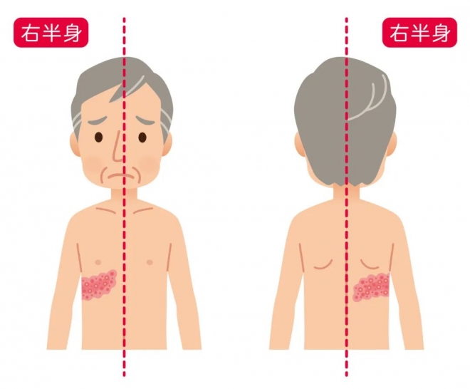 带状疱疹“痛”上热搜，哪些人容易得？