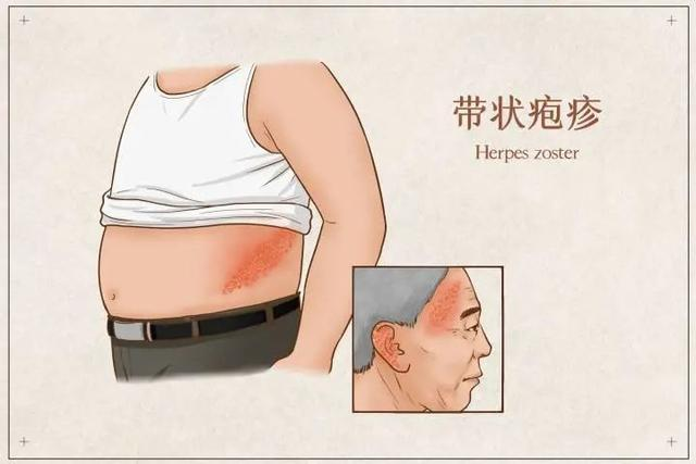 带状疱疹“痛”上热搜，哪些人容易得？