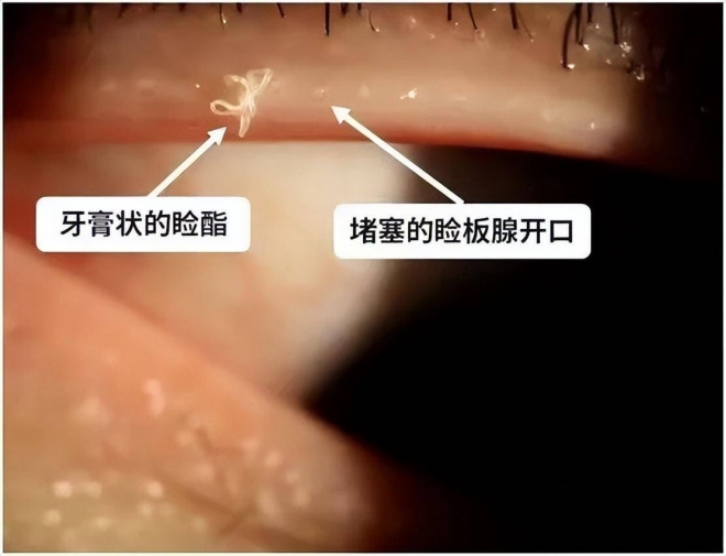 眼皮里竟然挤出这种东西？苏州九龙医院提醒切勿用眼过度
