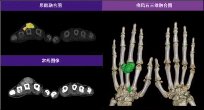 做个CT就能查出痛风！苏州九龙医院再添新设备，实力再提升