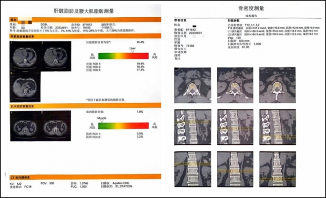 打个喷嚏还能骨折？苏州九龙医院：这类人特别容易中招