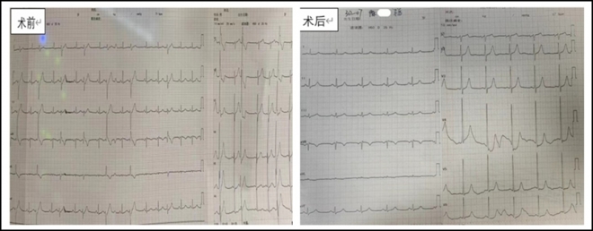 苏州九龙医院成功开展复杂心律失常乳头肌室早导管射频消融手术