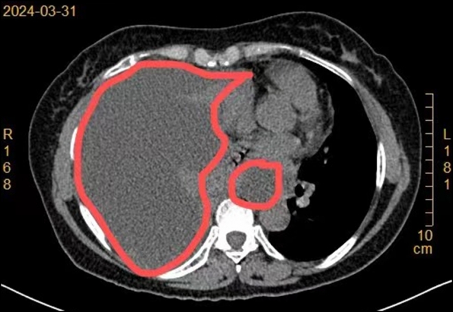 咳嗽、气喘竟是胸腔积水！苏州九龙医院“神探”为阿姨解除后顾之忧