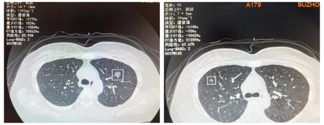  体检查出肺结节，寝食难安！医生“一刀一针”解女子难题