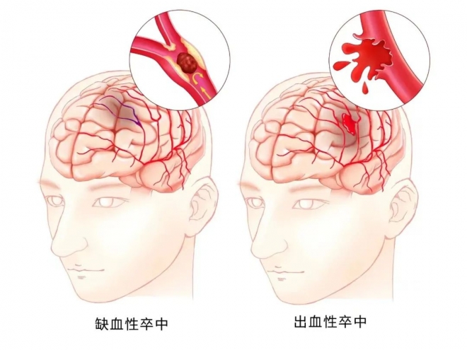 接连5例！低温天，这种病高发，家有老人要当心……