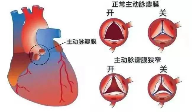 高龄！高危！心血管内科又一例TAVR手术成功让87岁老人化险为夷