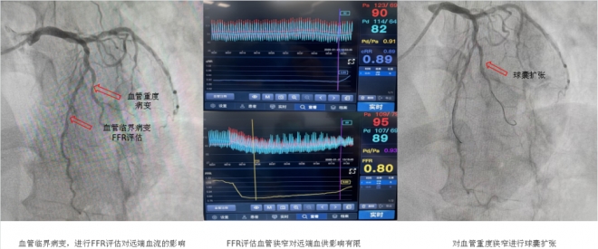 西苑医院苏州医院：冠脉介入治疗新时代，精准守护“心”健康！