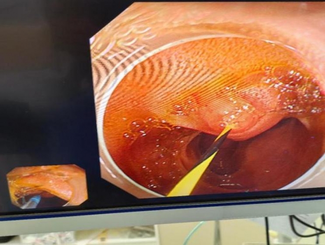 苏州市中医医院：仁心巧技破困局，内镜引流解急症