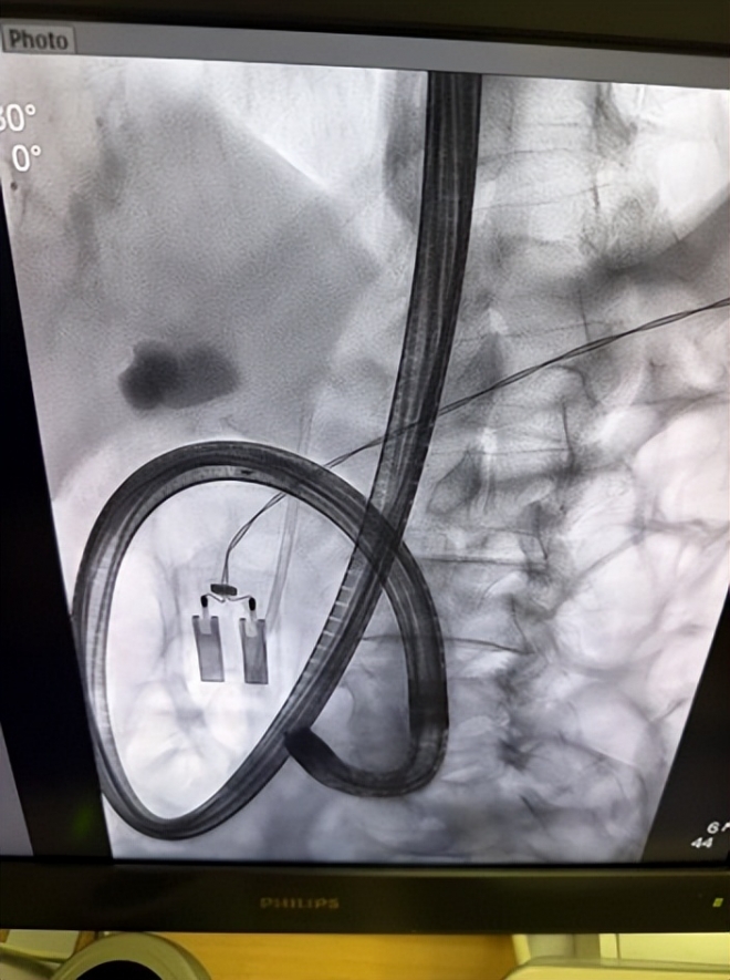 苏州市中医医院：仁心巧技破困局，内镜引流解急症